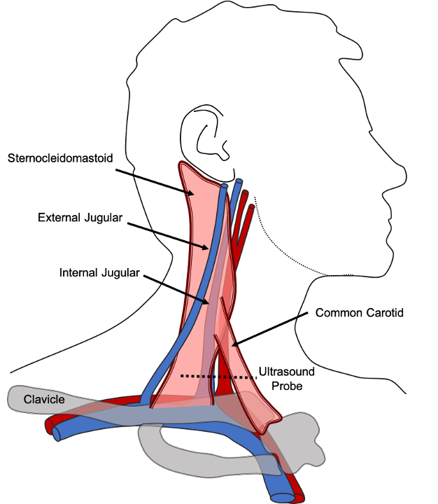 external jugular vein cannulation